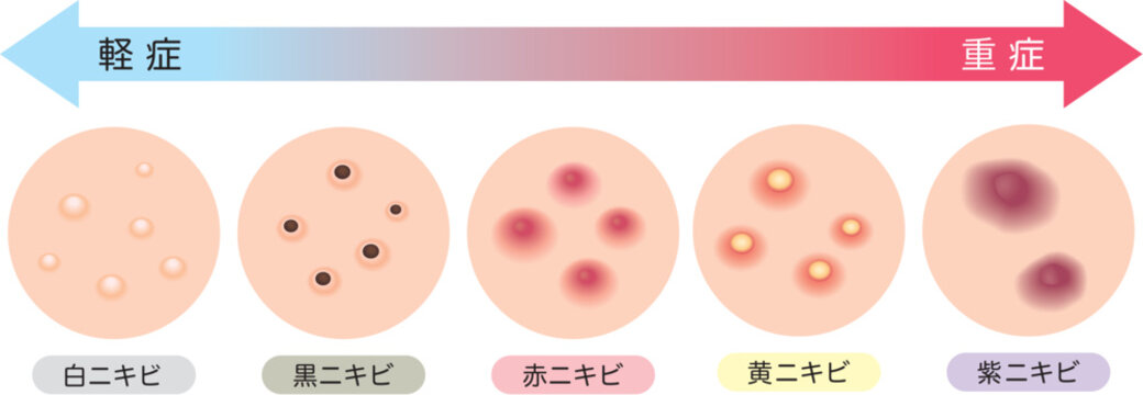 ニキビの炎症度の過程