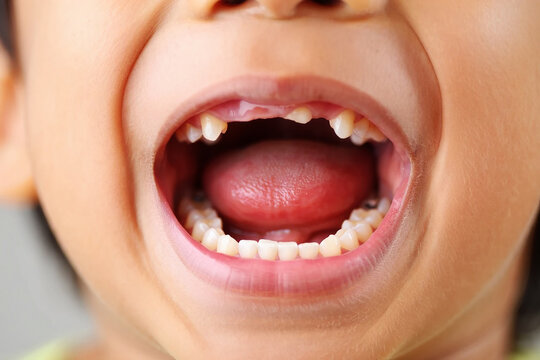 Close up of a childs open mouth showing missing front teeth and tongue image