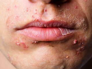 Close up of human lips and skin with dry cracked texture and red spots image