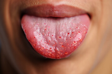 Obraz premium Close up of human tongue with red inflamed papillae and white coating mouth body