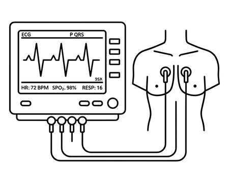 Ecg display with attached sensors showing vitals like heart rate and oxygen level of patient