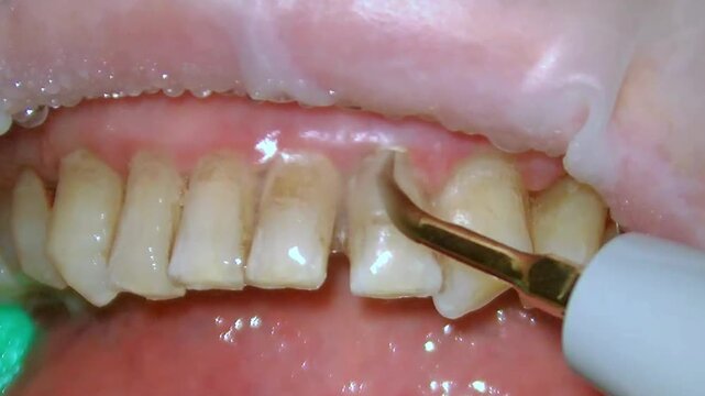 teeth cleaning