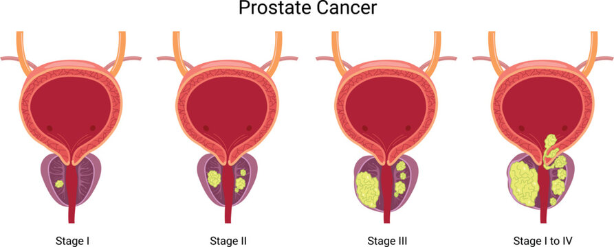 Prostate cancer. Four stages of an enlarged prostate gland with a tumor. Medical concept.
