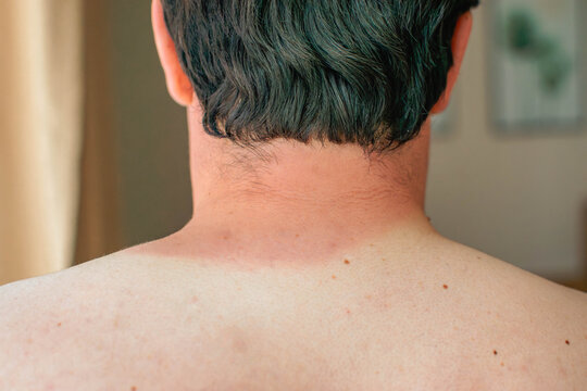 close-up of man&rsquo;s neck with distinct sunburn line and bare back