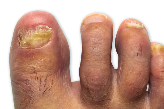 toenail fungus with onychomycosis at peak Infection in fungal foot nail