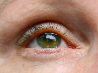 Obraz premium Nahaufnahme: gerötetes Auge mit Tränen und geschwollenem Augenlid vom weinen