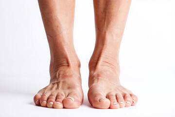 Amyotrophic Lateral Sclerosis Close up of human feet with visible veins and toes against a white