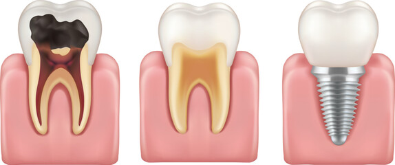 3D vector medical illustration cross section showing decayed tooth with cavity healthy tooth and dental implant metal screw gums isolated on background dentistry education concept