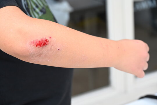 Bloody wound on the elbow and knee,