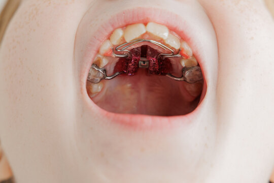 Close-Up Of Child's Mouth With Orthodontic Braces And Palatal Expander In Bright Dental Treatment Stage