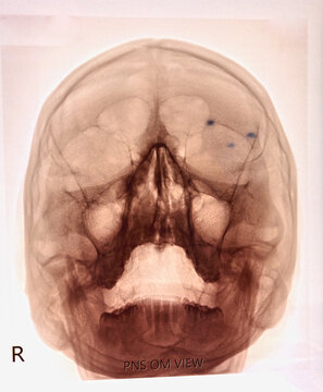 X-ray of human skull frontal view. Visible paranasal sinuses. Suggestive of rhinitis hit.