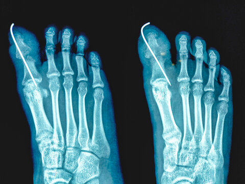 X-ray of human foot. Old fracture and dislocation is noted in gerate toe phalanges with internal fixation.