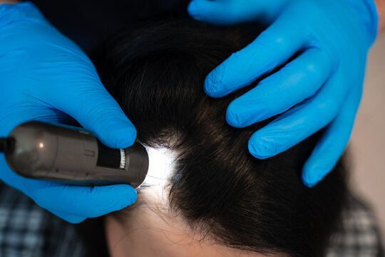 Professional trichology examination using digital trichoscope on scalp.