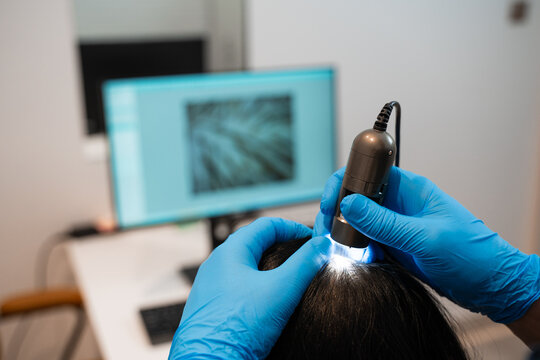 Trichology examination using digital trichoscope for hair and scalp health.