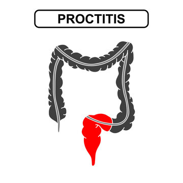 Illustration of proctitis ulcerative colitis. Inflammation of the human digestive system. Inflammatory bowel disease, Inflammation of the human digestive system. Vector illustration for medical poster