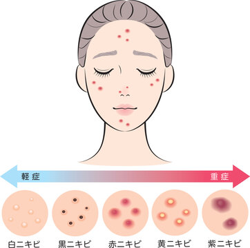 ニキビがある若い女性とニキビの種類のセット