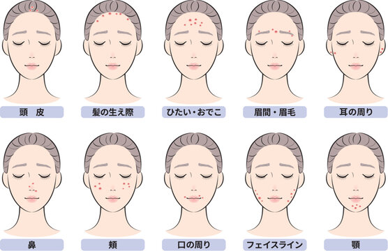 ニキビができやすい顔の部位セット