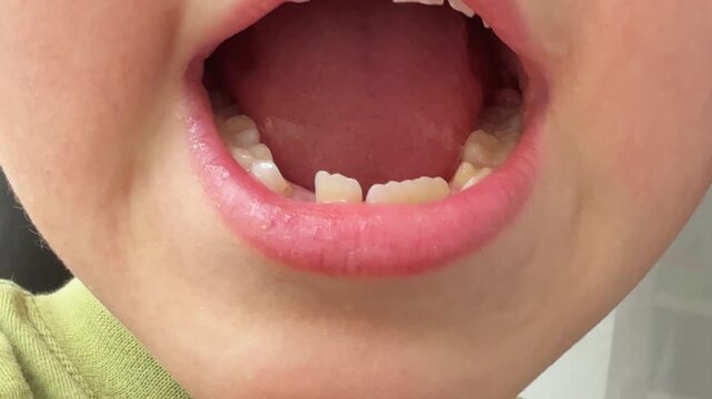 Closeup Child Open Mouth Showing Gap, Bright Bathroom Portrait Capturing Missing Front Teeth, Playful Grin