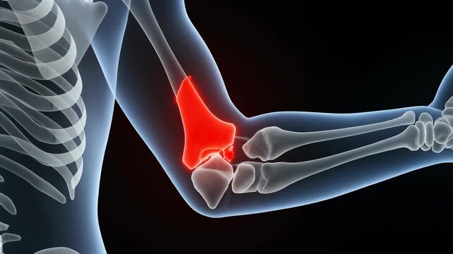 Medical 3D illustration highlighting acute elbow pain with red inflammation marker on the distal humerus bone indicating joint injury or arthritis.