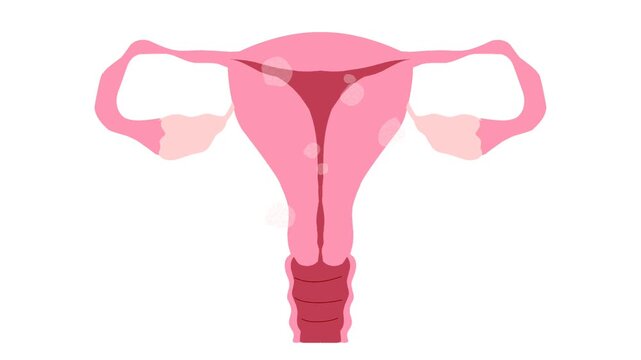 Female reproductive system with uterine fibroids Illustration animation