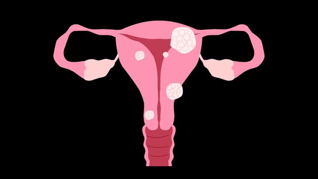 Female reproductive system with uterine fibroids Illustration animation