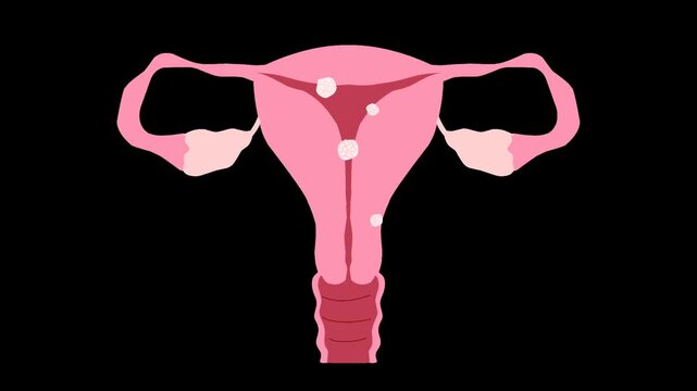 Female reproductive system with uterine fibroids Illustration animation