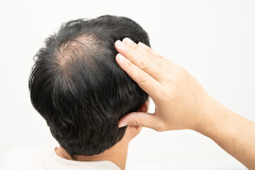 Fototapeta premium Bald in the middle head and begin no loss hair glabrous of mature man.