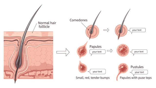 Acne Formation Diagram: Normal Hair Follicle to Comedones, Papules, and Pustules, Medical Illustration for Skincare and Dermatology Education