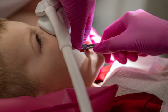 Dentist extracting baby tooth from child during dental procedure