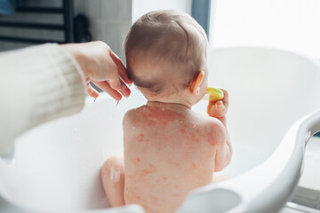 Obraz na płótnie Canvas Close up of baby skin with atopic dermatitis. Mother bathing her daughter with eczema. Mom taking care of infant at home