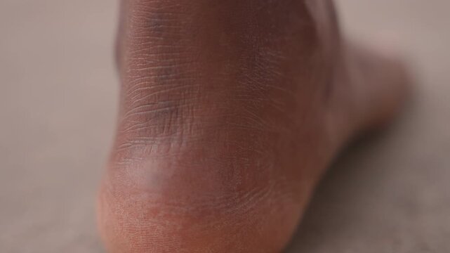 Foot skin examination. Clinic view of foot condition. Medical evaluation of heel for healing and skin health. Detailed clinical examination focusing on dry skin and callus treatment process