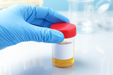 Urology. Laboratory worker with container of urine sample for analysis at white table, closeup © New Africa