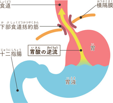胃酸の逆流のイラスト　Acid reflux illustration