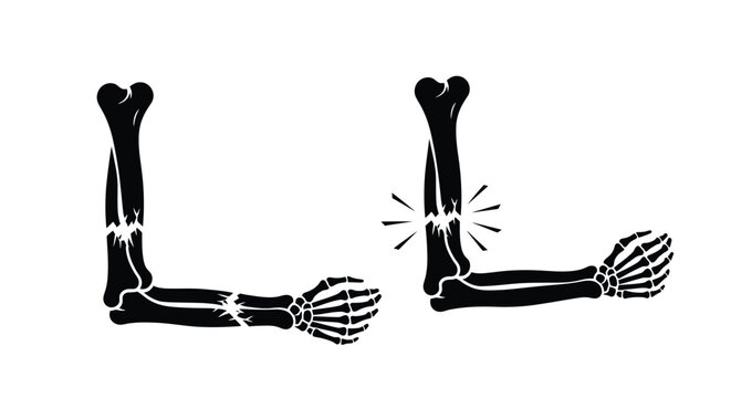 Black and white illustration of two fractured arms with hands