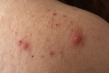 Fototapeta premium Pimple macro closeup on inflamed skin. Pimples closeup detail for dermatology. Pimple macro texture on skin. Skin problem. Acne closeup. Acne oily skin in puberty. Dermatology concept.