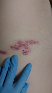 This shows a rash on the back of a patient resulting from herpes zoster virus infection. The skin shows lesions commonly associated with this condition.