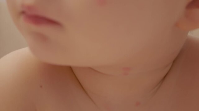 Close look at the face and eyes of a child with chickenpox. Spots appear on the skin. The child seems to show signs of the illness and discomfort.