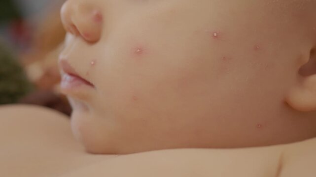 A child has chickenpox with blisters appearing on the face. The child is in a home setting. Parents may be concerned about the condition and its effects.