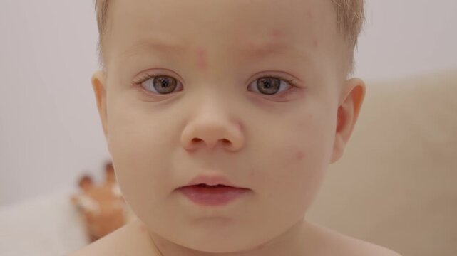 A child shows early signs of chickenpox with small spots appearing on the face. The child is in a home environment. Close-up focus is on the child's expression.
