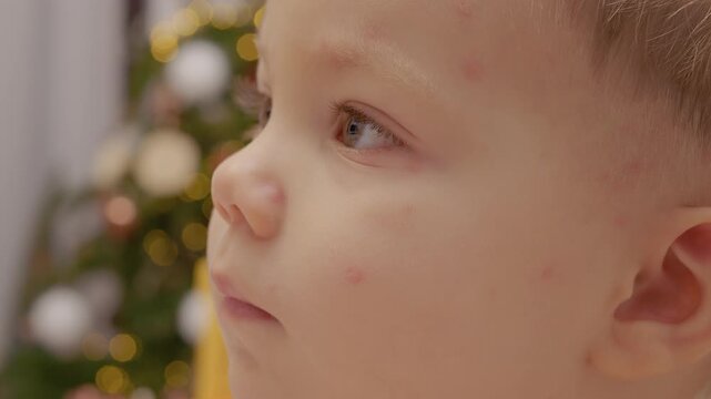 A child sits in a home setting, showing signs of chickenpox on their face and skin. The close-up captures the child's eyes and pox clearly, highlighting the condition.