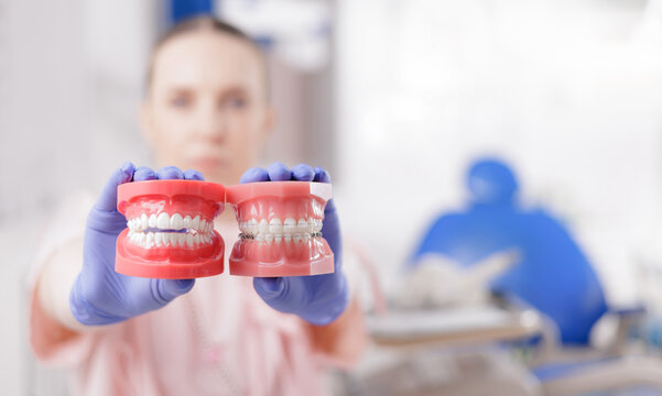 Dentist holding dental models for comparison invisalign aligner or system of braces for straightening teeth in clinic