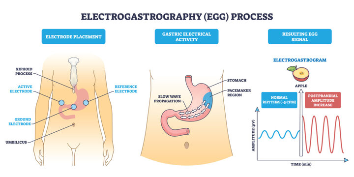 Electrogastrography process diagram shows electrode placement, gastric slow-wave propagation, and EGG waveform, key objects, electrodes, stomach, signal graph. Outline diagram