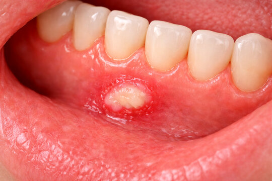 Oral Canker Sore on Inner Lip &ndash; Aphthous Ulcer