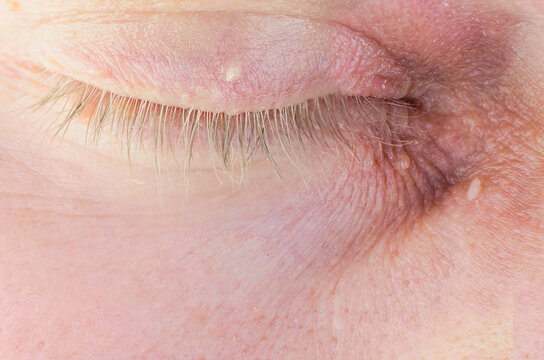 Papilloma on the eyelid of an adult man