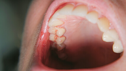 Fototapeta premium Extreme close-up of an aphthous ulcer, or canker sore, on the inner cheek mucosa. This medical macro image shows oral inflammation and stomatitis, highlighting dental health and oral pathology