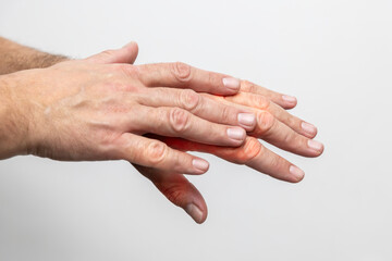 Hand pain, close-up of male hands on a white background
