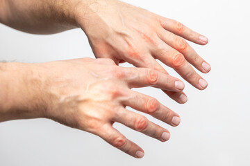 Hand pain, close-up of male hands on a white background
