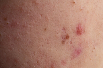 Fototapeta premium Acne on skin closeup. Acne macro pimple on skin. Acne texture in pores. Acne macro for dermatology.