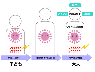 帯状発疹のしくみ