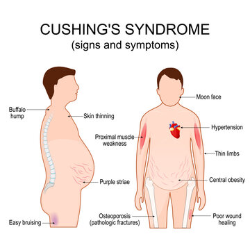 Cushing's syndrome. Signs and symptom of Cushing disease.